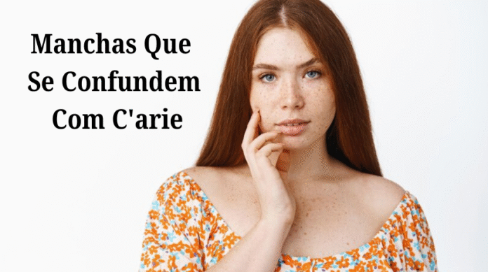 Manchas Que Se Confundem Com C'arie